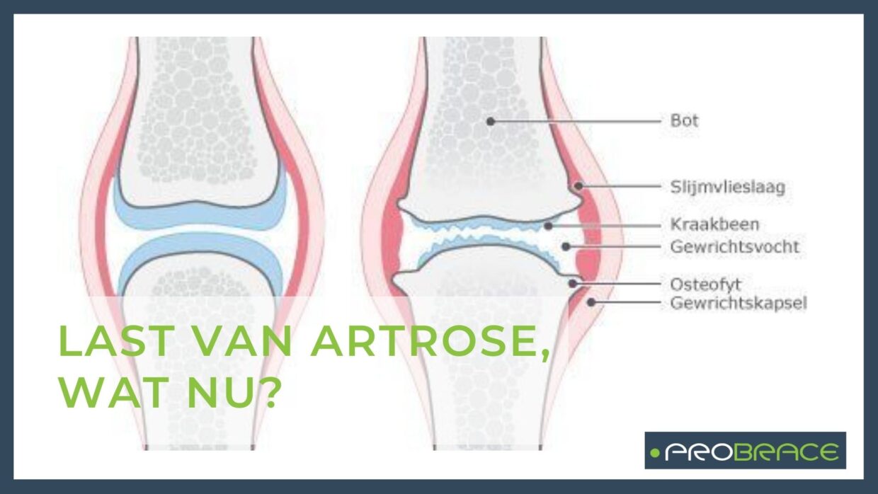 Last Van Artrose Wat Nu